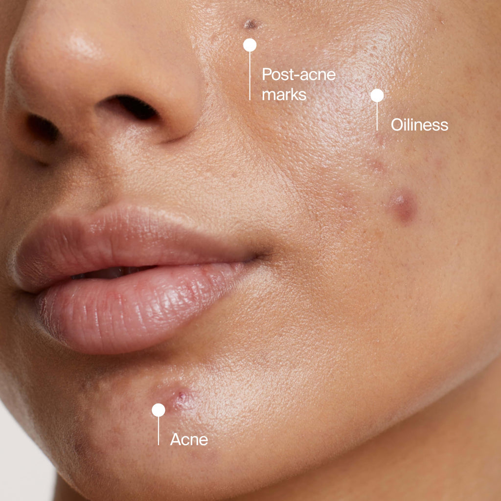 Neutrogena Evenly Clear Acne Cleansing Face Mask with 3.5% Benzoyl Peroxide Treats Breakouts & Bentonite Clay, Purifying Clay Mask Absorbs Oil to Visibly Improve the look of Skin, 4.2 fl. oz